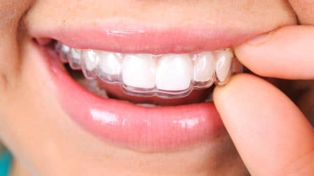 4 INVISIBLE AESTHETIC ALIGNERS